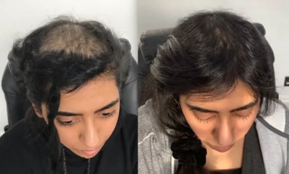 Hair Restore