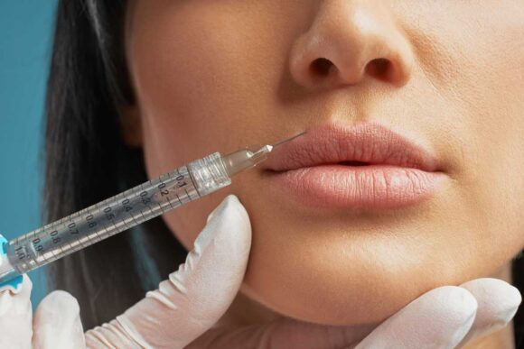 Lip Filler