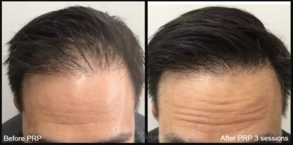 Prp Therapy