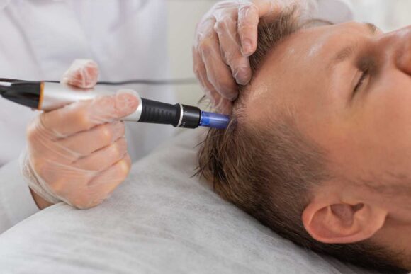 Scalp Microneedling