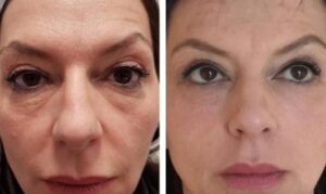 Beforeandafter