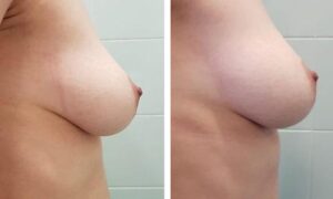 Beforeandafter10