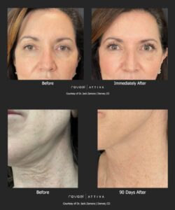 Beforeandafter12