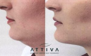 Beforeandafter5