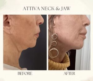 Beforeandafter9